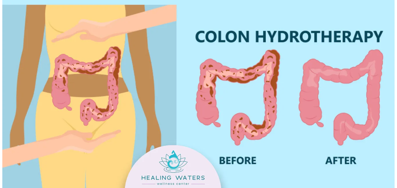 Illustration of the colon before and after colon hydrotherapy