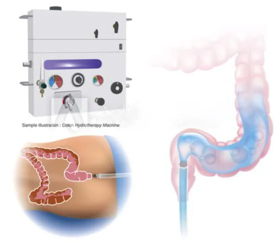 Closed-system colon hydrotherapy equipment and how it works
